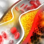 cholesterolis-kemsa-kraujagysles-599c227183831