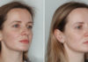 Kaip greitai ir paprastai pašalinti amžiaus dėmes? Štai keli receptai, kurie padės!